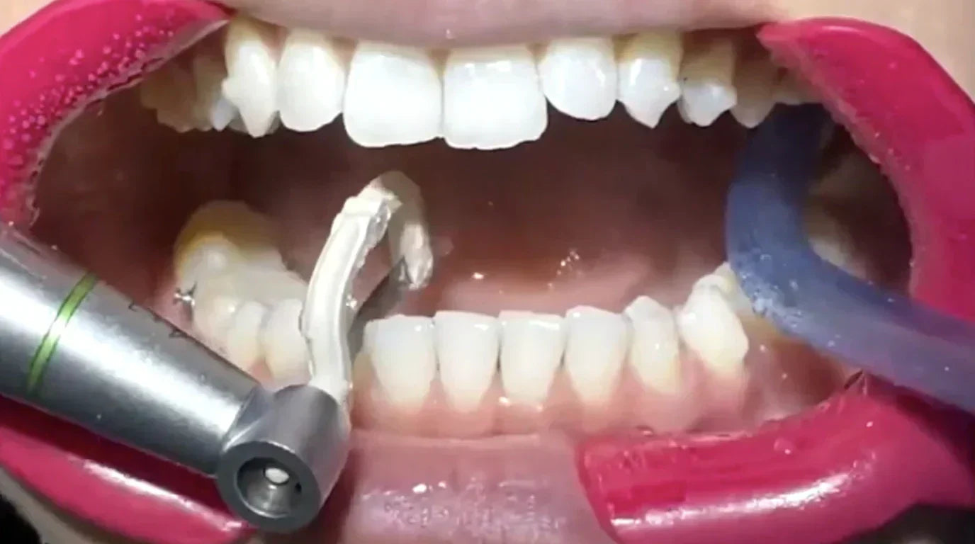The Evolution of Interproximal Reduction (IPR): Why the Dentasonic System Outperforms Traditional Methods