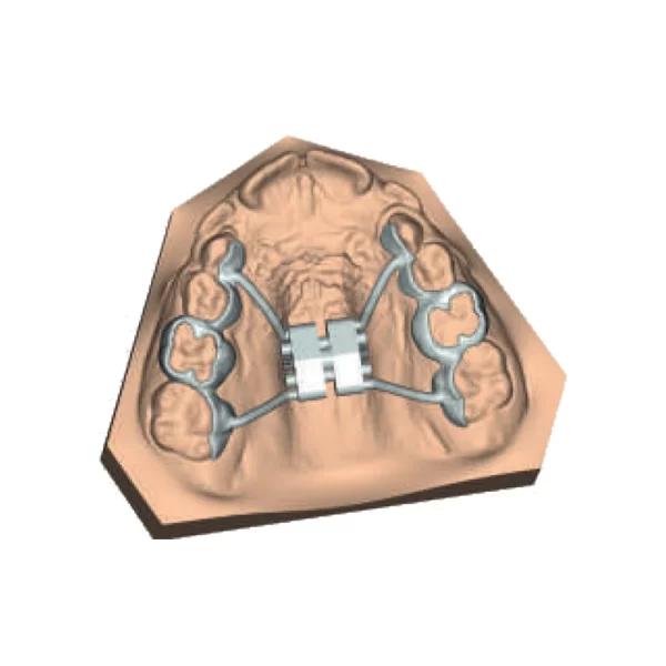 CAD-CAM Rapid Expander - Tooth Borne