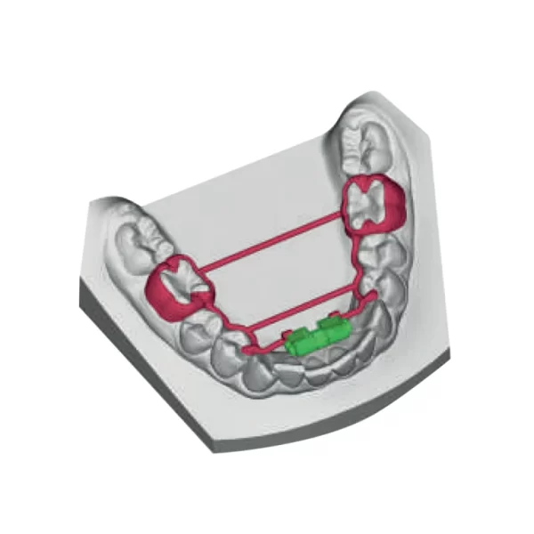 Leone CAD-CAM Expander for Lower Arch — Tooth Borne