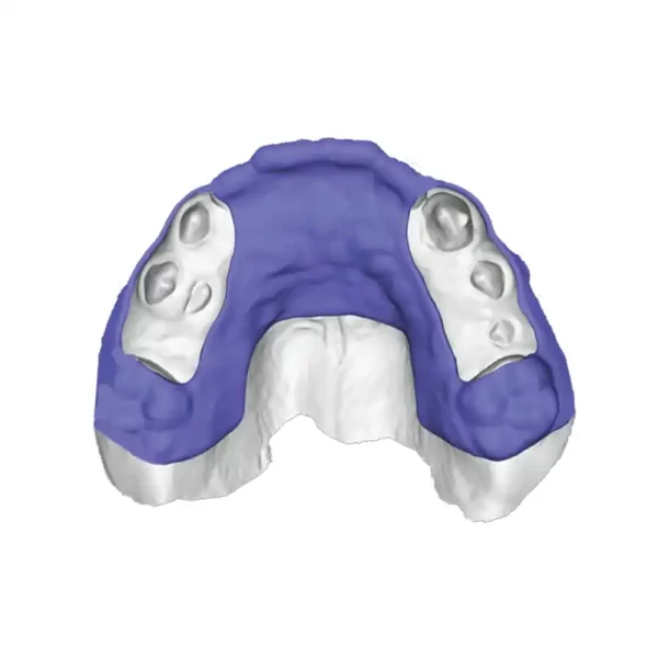 Alohaligner™ Transitional Retainer System from 3DNA™ Dental