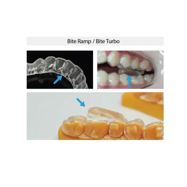 Bite Ramps with the 3DNA™ Aligner System