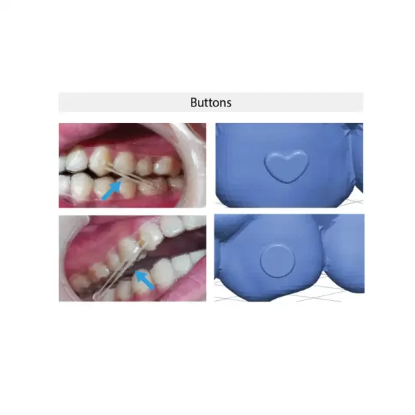 Buttons with the 3DNA™ Aligner System