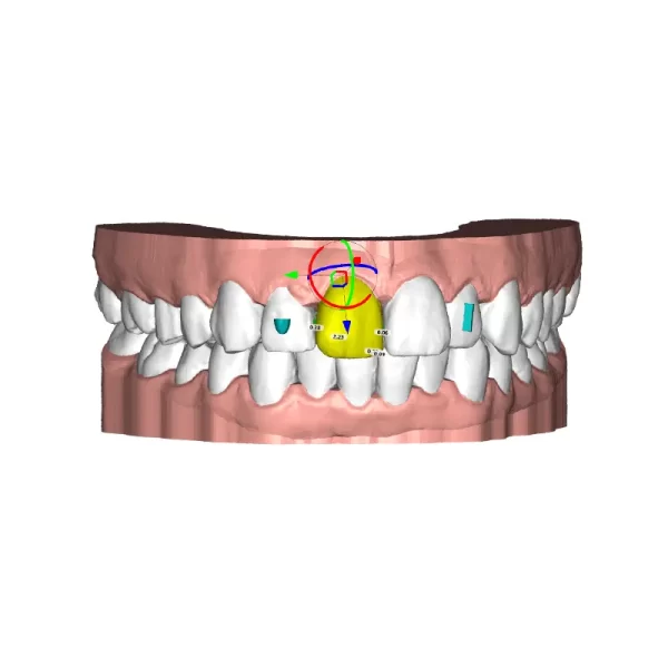 Deltaface Aligner Software