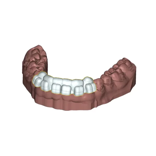 Deltaface Indirect Bonding Software