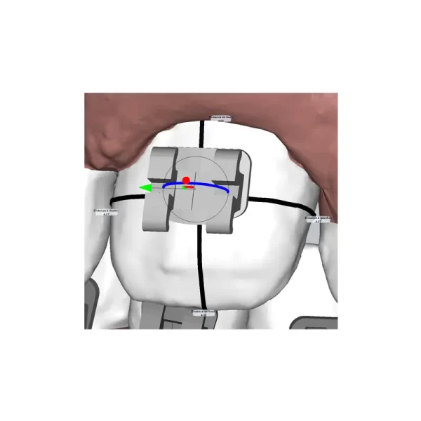 Deltaface Indirect Bonding Software