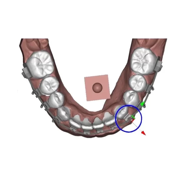 DeltaFace UBrackets Customized Brackets Software from 3DNA Dental