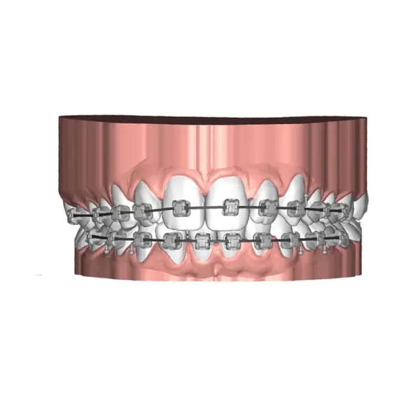 DeltaFace UBrackets Customized Brackets Software from 3DNA Dental