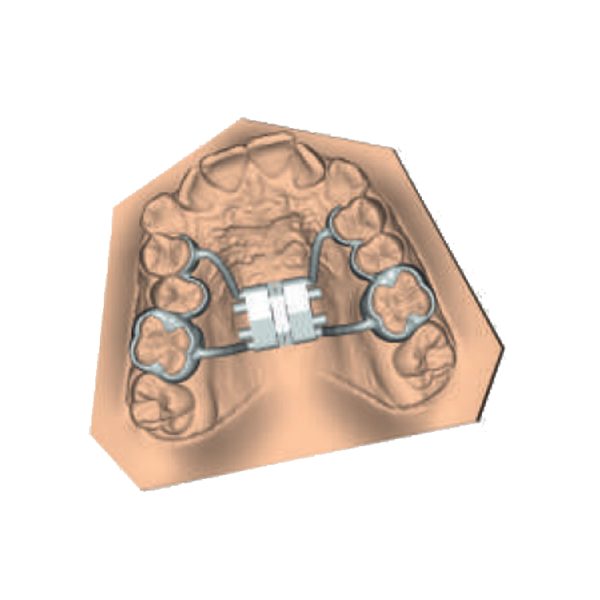 Leone CAD-CAM Leaf Self Expander — Tooth Borne