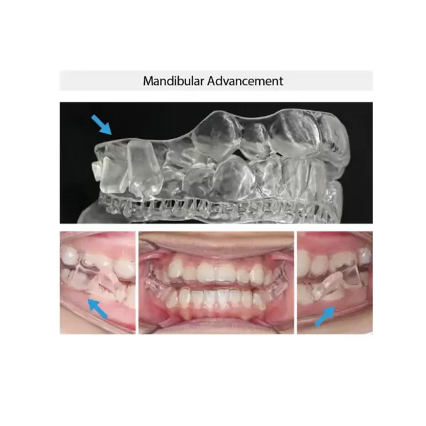 Mandibular Advancement with the 3DNA™ Aligner System