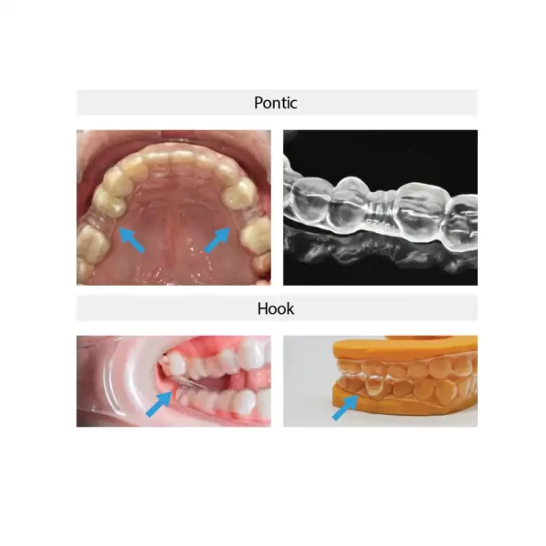 Pontics & Hooks with the 3DNA™ Aligner System