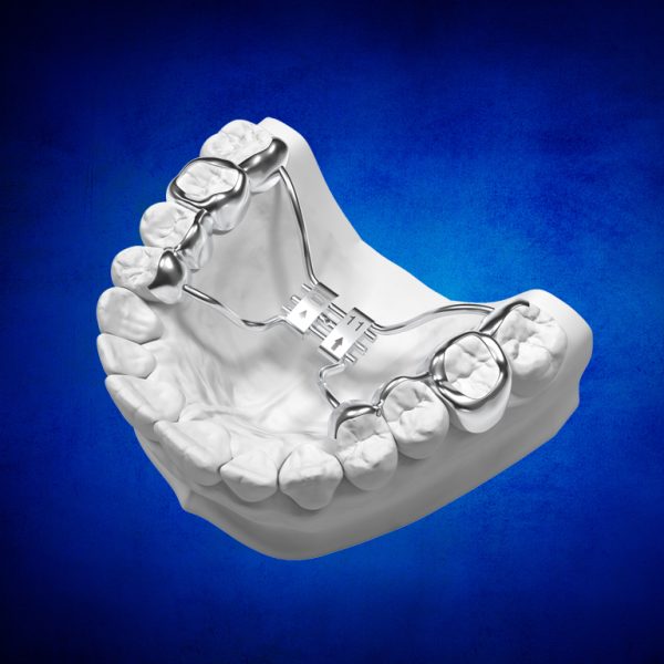 Metal Printed Frame Work for REPs from 3DNA Dental Lab