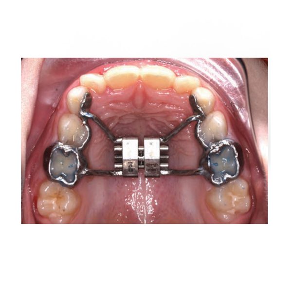 Metal Printed Frame Work for REPs from 3DNA Dental Lab