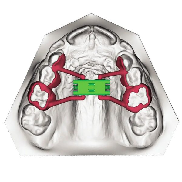 Metal Printed Frame Work for REPs from 3DNA Dental Lab